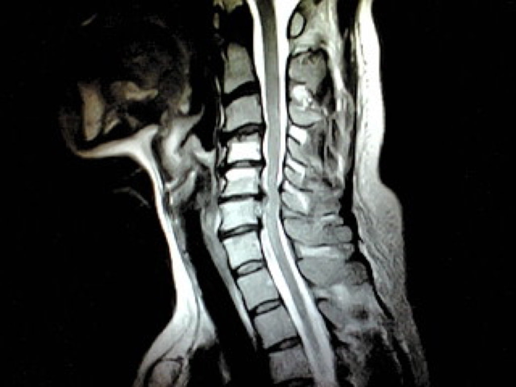 頚椎MRI画像