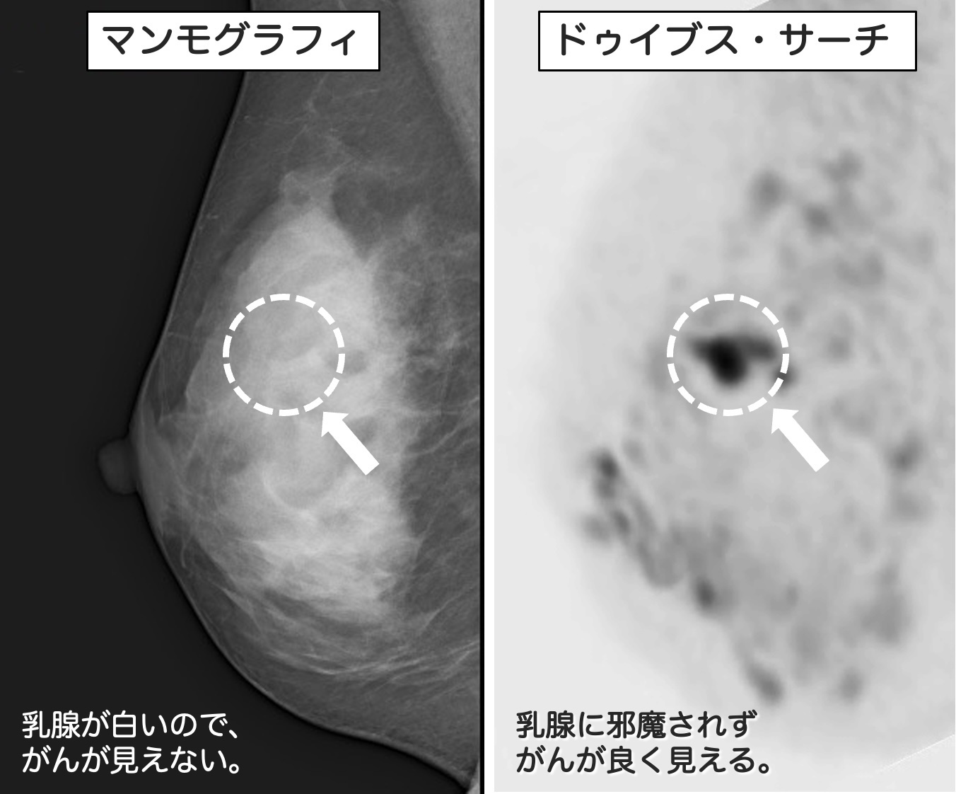 DWIBS画像